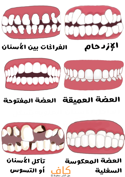 رسم توضيحي للأشكال المتعددة لتشوهات الأسنان والتي تظهر فيها الأسنان إما متباعدة أو متراكبة او داخلة أو خارجة أو متآكلة