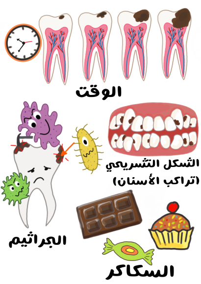 رسم توضيحي لمجموعة من الأسنان ويظهر عليها تطور التسوس الأسود تدريجياً مع مرور الوقت ورسمة لسن عليه تسوس كبير أسود وحوله مجموعة من الجراثيم المختلفة التي تحيط به بالإضافة لسكاكر ولوح من الشوكولاتة