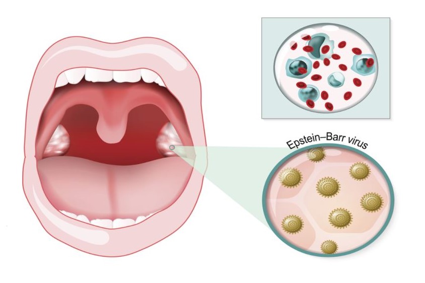 About Mono (Infectious Mononucleosis)