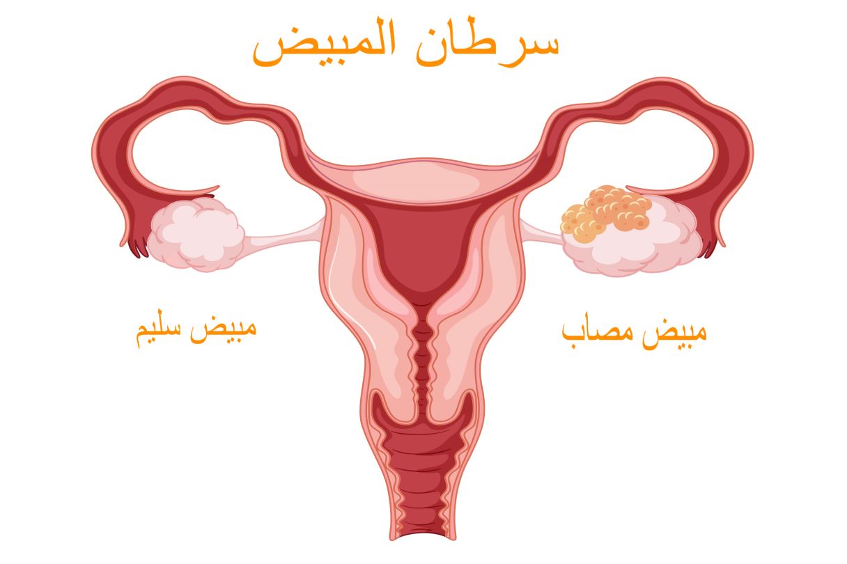 رسم تشريحي للجهاز التناسلي عند المرأة مع وجود العديد من الكريات الصغيرة على الجهة اليمنى من الجهاز التناسلي