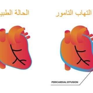 رسم توضيحي للقلب عند تعرضه لالتهاب التامور