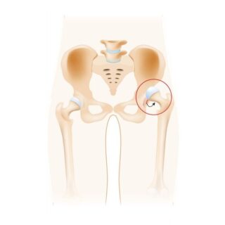 رسم توضيحي لرأس عظم الفخذ وهو خارج التجويف الحقي للورك