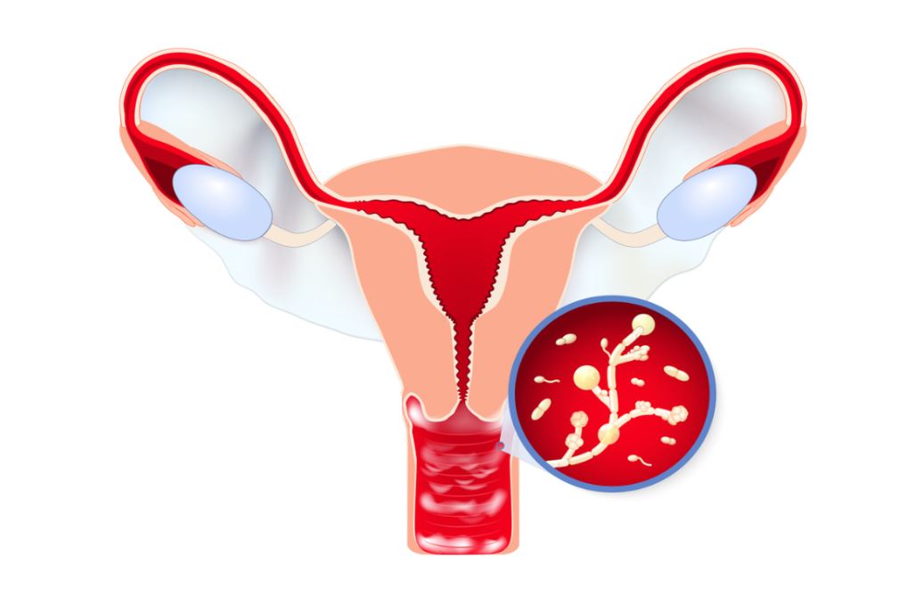 رسم توضيحي لالتهاب المهبل الفطري عند النساء