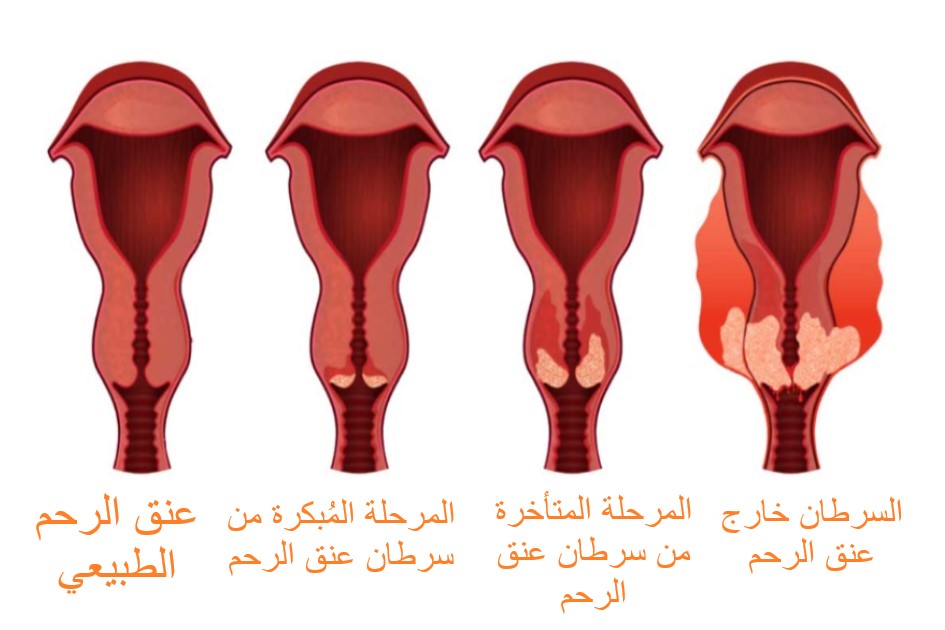 رسم توضيحي لمراحل تطور سرطان عنق الرحم لدى المرأة