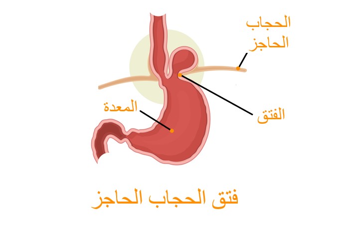 رسم توضيحي لظهور كتلة فوق المعدة