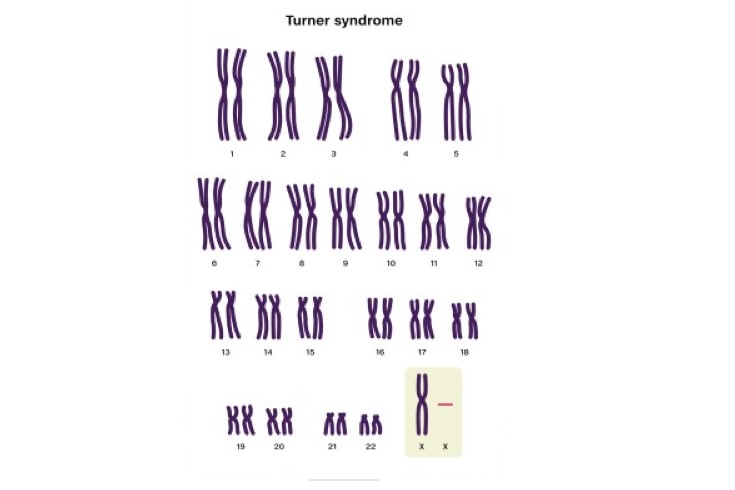 رسمة توضيحية لصبغيات متلازمة تيرنر
