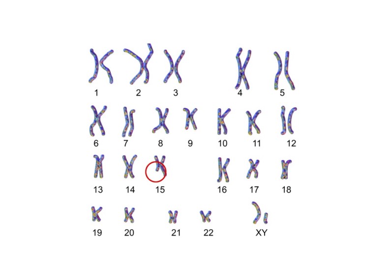 رسم توضيحي يظهر خلل جيني بالصبغي رقم 15