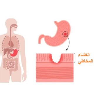 رسمة توضيحية لمعدة إنسان مصابة بتقرح