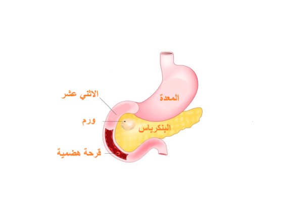 رسم توضيحي لورم يصيب البنكرياس