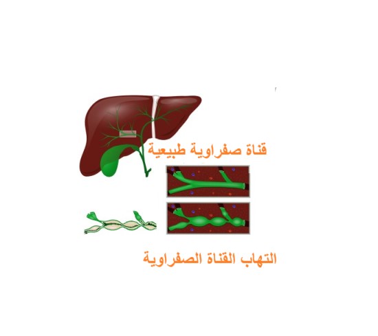 رسم توضيحي للكبد والتهاب القناة الصفراوية