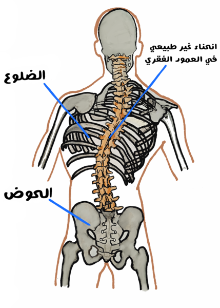 رسم توضيحي للهيكل العظمي للإنسان من الخلف ويظهر انحناء في العمود الفقري