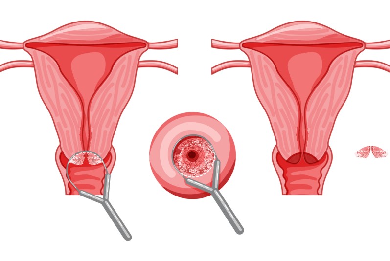 رسم توضيحي لخزعة من عنق الرحم