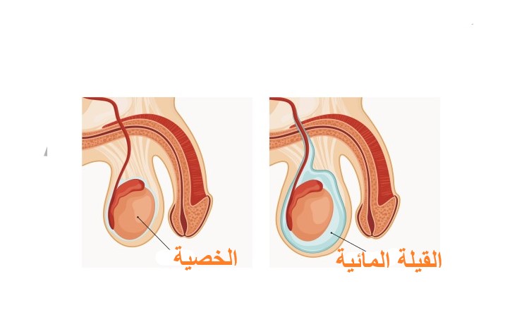 رسم توضيحي لتموضع القيلة المائية ضمن الخصية