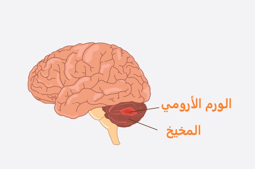 رسم توضيحي لورم موجود داخل المخيخ