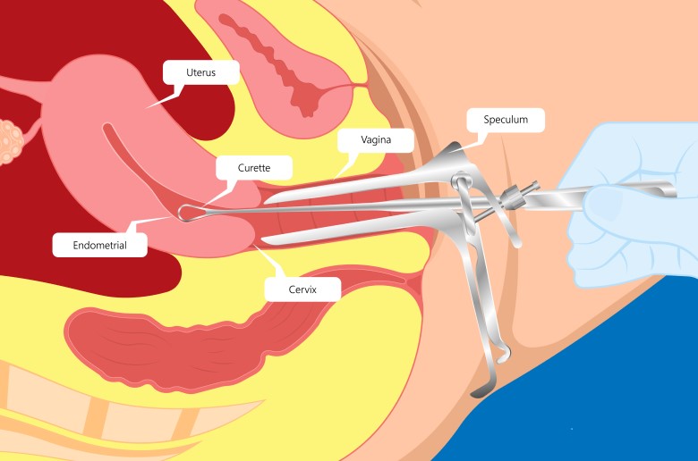 رسم توضيحي لتجريف وتوسيع الرحم