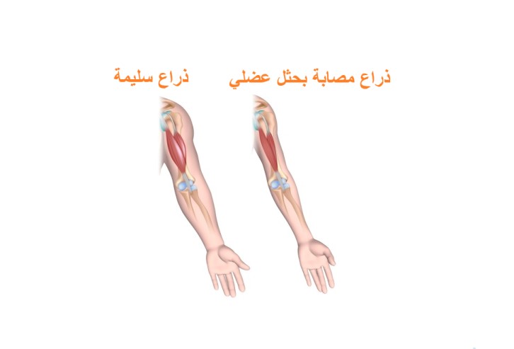 ذراع سليمة وذراع مصابة بضمور عضلي