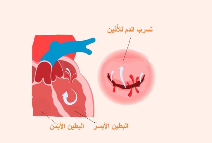 رسم توضيحي لقصور الصمام التاجي