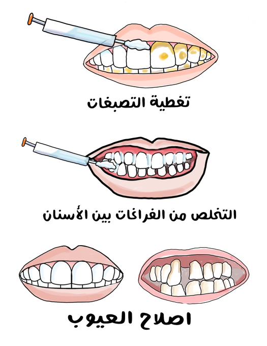 رسم توضيحي لمجموعة من الأسنان المتصبغة والمشوهة وبجانبها إبرة طبية تقوم بإصلاحها