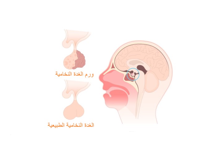 رسم توضيحي لورم الغدة النخامية