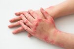 يدّ شخص مصاب بمرض جلدي على شكل تقرحات وقشور حمراء على الجلد