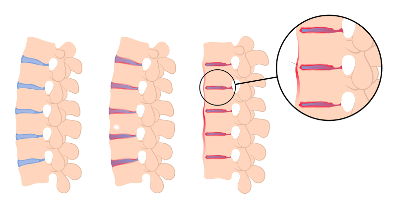 رسم توضيحي للفقرات في العمود الفقري بحالتها الطبيعية وبحالة اصابتها بالالتهاب