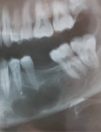 صورة شعاعية لكيس سنّي موجود تحت الأسنان