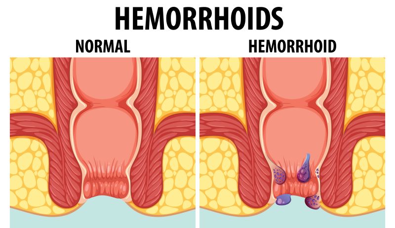 رسم توضيحي لوجود البواسير ضمن فتحة الشرج