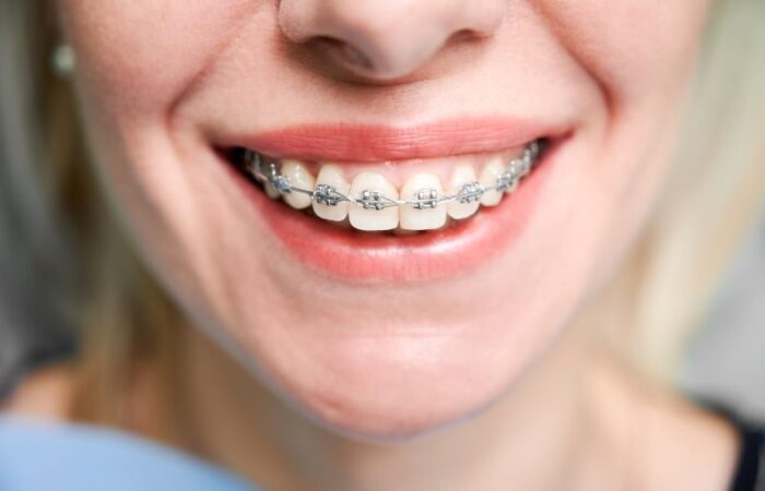 أسنان امرأة مبتسمة عليها سلك معدني