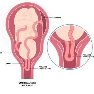 رسم توضيحي لجنين داخل الرحم وتدلي الحبل السري داخل عنق الرحم