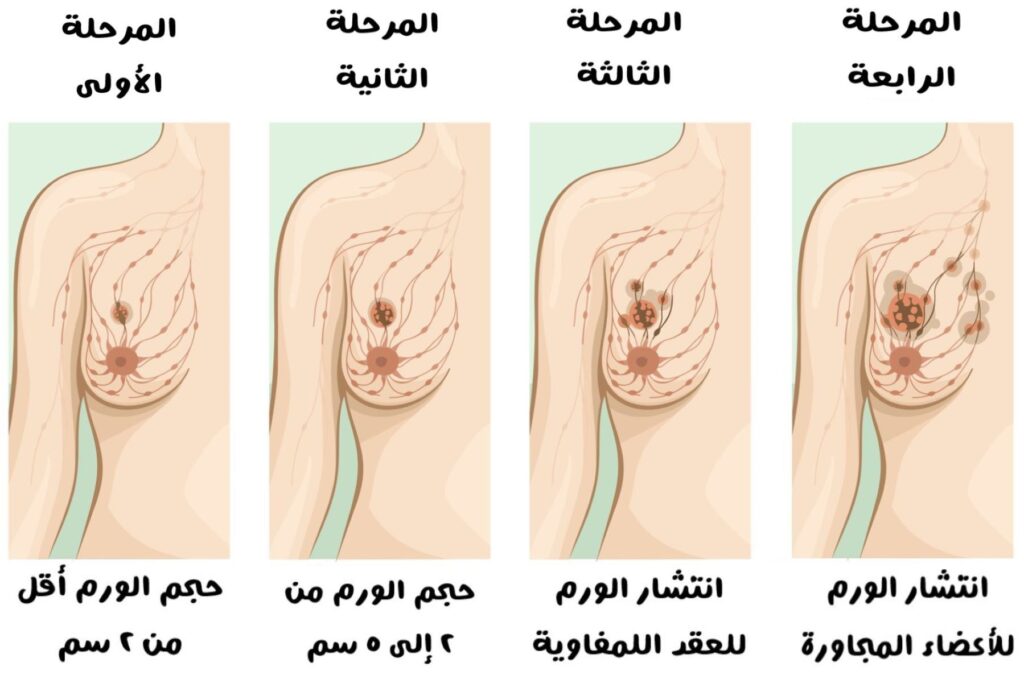 رسم توضيحي لأربع أثداء أنثوية يتدرج فيها تطور ورم الثدي من حجم صغير وحتى عدة أحجام كبيرة منتشرة في كامل الصدر