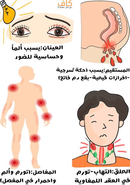 رسم توضيحي لقطرات من الدم تخرج من فتحة الشرج لشخص ما، وشخص آخر عيناه حمراوان وبجانبهما لمبة صفراء، بالإضافة لشخص يظهر احمرار في كامل مفاصل جسمه