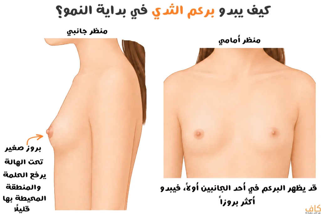 شكل برعم الثدي عند البنات في بداية البلوغ من الأمام والجانب، مع توضيح البروز الصغير تحت الهالة وإمكان ظهوره في أحد الجانبين أولًا.
