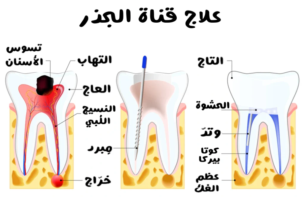 رسم توضيحي يشرح علاج قناة الجذر، ويعرض سنًا مصابًا بتسوس عميق والتهاب في العصب مع خراج، ثم مرحلة تنظيف قناة الجذر باستخدام أداة طبية، وأخيرًا حشو القناة بمادة خاصة مع إغلاق السن بالحشوة والتاج.